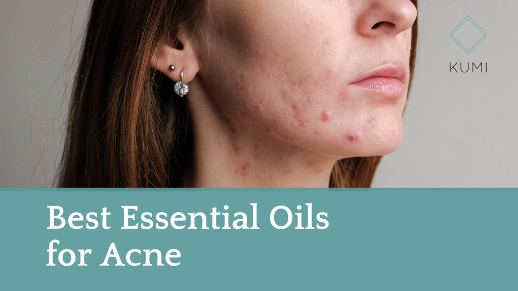 Best Essential Oils for Acne